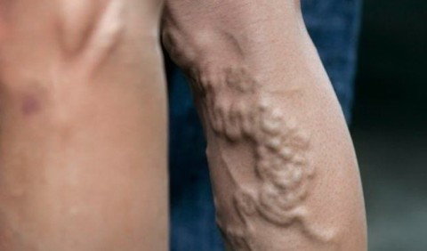 Ефективне лікування варикозу ніг: особливості та ціна лазерної операції