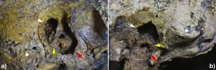 Знайдено череп людини зі слідами найдавнішої операції – 2