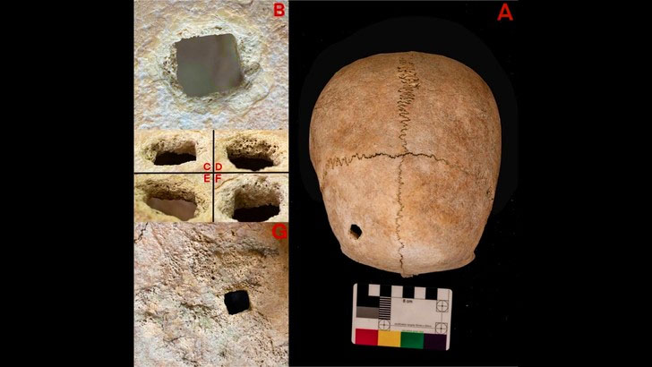 Радикальна медицина – навіщо 4000 років тому в Італії дівчину поховали з цвяхом у голові