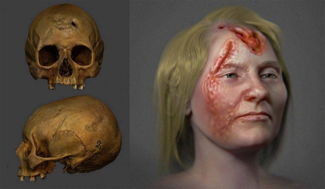 Відновлено вигляд середньовічної жінки, яка страждала від сифілісу