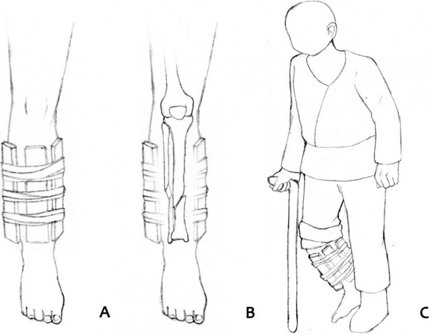 Стародавньому кочівнику з Китаю наклали шину на зламану ногу близько 2400 років тому – 2